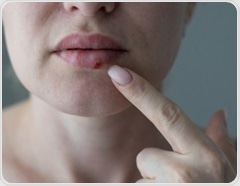 Antiviral drugs and shingles vaccines tied to lower dementia risk