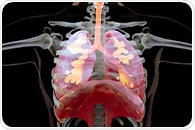 Study identifies four radiomic profiles linked to sarcoidosis severity