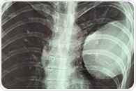 Lung tumors shift identity making treatment more difficult