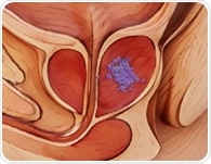 Metformin boosts an exercise-linked metabolite and may help control weight in prostate cancer patients