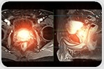 Targeted fluorescent probes for high-contrast cancer detection