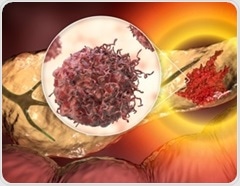 Why do the deadliest cancers still get less NIH research funding?