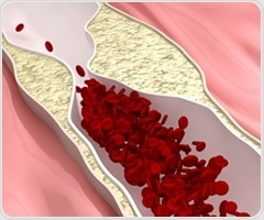 Specific intestinal fungi play role in the pathogenesis of MASLD and cardiovascular disease