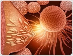 Intermediate PRRX1 levels drive breast cancer metastasis risk