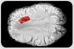 Hyperbaric oxygen therapy shows dual effects in glioblastoma treatment