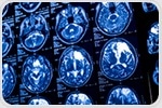 Noninvasive brain monitoring reveals hidden oxygen deprivation in ICU patients