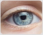 AI and polarized light improve early detection of keratoconus