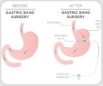 U.S. bariatric surgery rates drop significantly amid GLP-1 surge