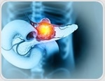 New AI model spots hidden pancreatic cancer long before diagnosis