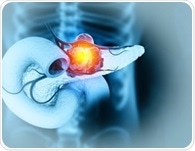 New AI model spots hidden pancreatic cancer long before diagnosis