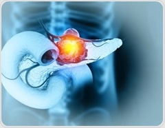 New AI model spots hidden pancreatic cancer long before diagnosis