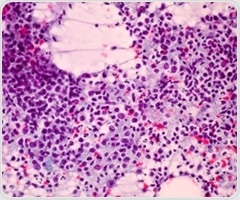 Common tuberculosis screening test could predict long-term patient survival