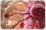 Vitamin D deficiency linked to higher postoperative breast cancer pain