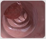 Targeting tumor-specific inflammatory process may prevent drug resistance in colon cancer