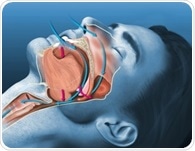 Oral AD109 improves sleep apnea severity but tolerability remains a challenge