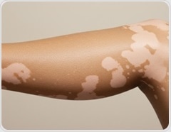 Diet and inflammation may play a role in progressive vitiligo