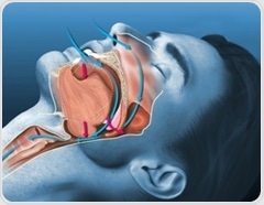 Oral AD109 improves sleep apnea severity but tolerability remains a challenge
