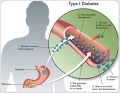 New therapies could help type 1 diabetes care move beyond insulin alone
