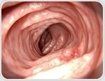 Gut changes linger years after polyp removal and may signal colorectal cancer risk