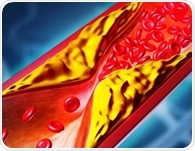 One-time gene editing cuts LDL cholesterol in early hypercholesterolemia trial