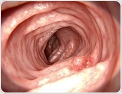 Gut changes linger years after polyp removal and may signal colorectal cancer risk