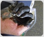 Study shows early disease activity predicts systemic sclerosis progression