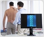 Study reveals distinct sociodemographic risk factors in rare myopathies
