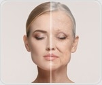 Study evaluates how facial aging features influence age perception in women