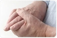 Continuing gout therapy during remission lowers future flare risk