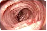Gut changes linger years after polyp removal and may signal colorectal cancer risk