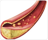 New calculator predicts statin-related muscle disorder risk