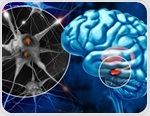 Short sleep and poor sleep quality track with Parkinson’s risk