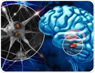 Short sleep and poor sleep quality track with Parkinson’s risk
