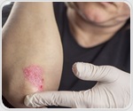Biohub researchers use artificial intelligence to uncover new psoriasis targets