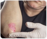 Biohub researchers use artificial intelligence to uncover new psoriasis targets