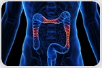 Using blood proteomics to identify pediatric inflammatory bowel disease risk
