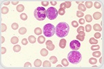 Enigmatic MLL4 Protein Drives Leukemia While Suppressing Solid Tumors
