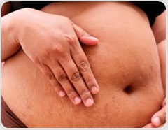 GLP-1 exposure in pregnancy does not clearly raise major birth defect risk