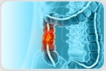 New study highlights noninvasive biomarkers for colorectal cancer detection