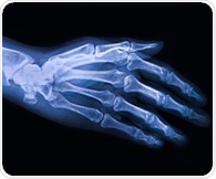 Oral microbiome imbalances may contribute to symptomatic hand arthritis