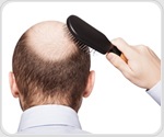 GLP-1 receptor agonists may increase hair loss risk