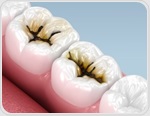 Large US trial supports silver diamine fluoride for severe early childhood caries