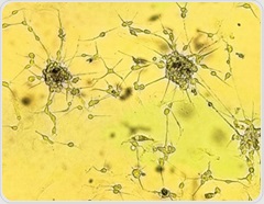 Cannabis compounds may weaken glioblastoma response to chemotherapy and radiation