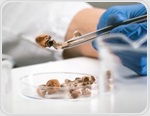 Single-dose psilocybin shows promise for treatment-resistant depression in NHS trial