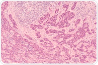 Study identifies a novel direct drug target for head and neck squamous cell carcinoma