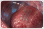 Bioresorbable sensor tracks deep-tissue lactate for over 10 days in animals