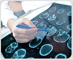 Paternal valproate use not linked to offspring neurodevelopmental risks