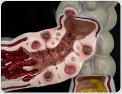Scientists found a distinct gut microbiome pattern in people with symptomatic diverticular disease