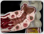 Scientists found a distinct gut microbiome pattern in people with symptomatic diverticular disease