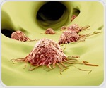 AI-based methods help uncover hidden roots of tumor metastasis